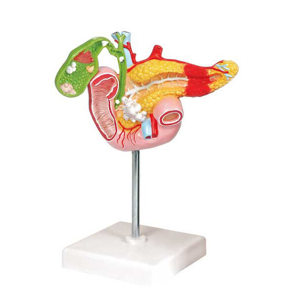 Модель патологических состояний поджелудочной железы, двенадцатиперстной кишки и желчного пузыря